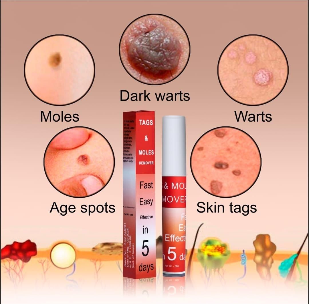 Tags & Moles Remover [BUY 1 GET 1 FREE]